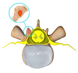 Spine tumor