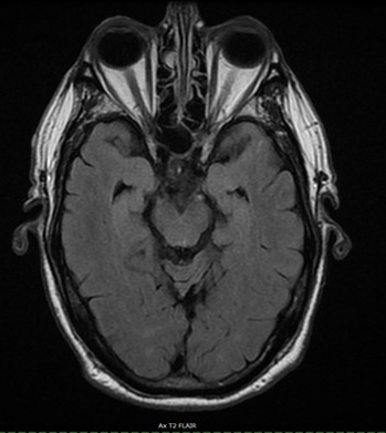 Neurological MRI Exams - Brain