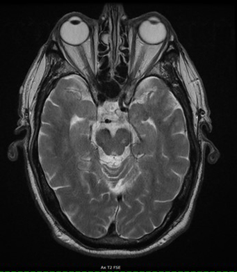 Neurological MRI Exams - Brain