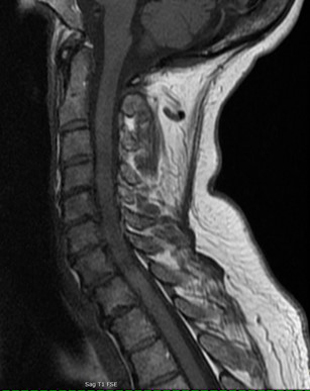 Neurological MRI Exams - Cervical