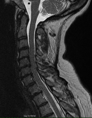 Neurological MRI Exams - Cervical