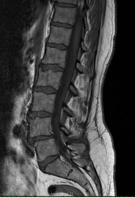 Neurological MRI Exams - Lumbar