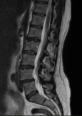 Neurological MRI Exams -  Lumbar